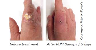 Treatment of Pain with Photo Biomodulation
