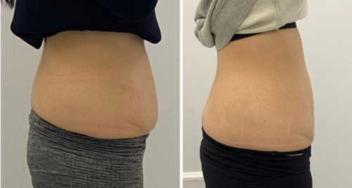 Body Sculpting and Skin Tightening Laser Treatments