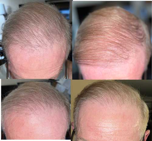 Top row is the after hair restoration laser treatments results; bottom row is the before