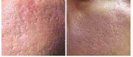 Acne scar treatment with laser resurfacing