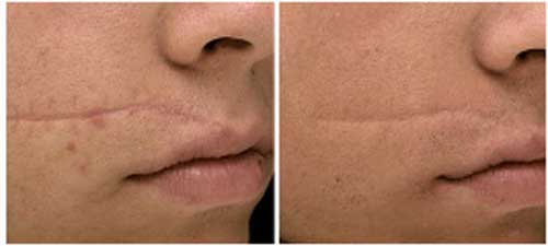 Facial Scar Removal Clinical Results