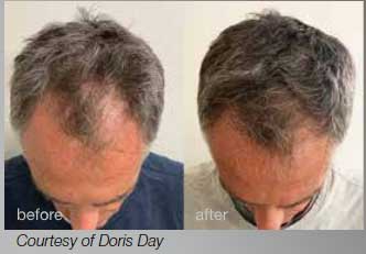 Hair restoration with laser therapy