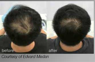 Laser hair treatment for hair loss - before and after