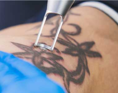 tatto removal with laser treatment