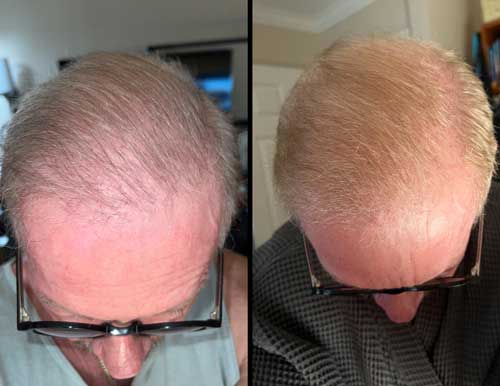 Hair after 2 1/2 laser treatments