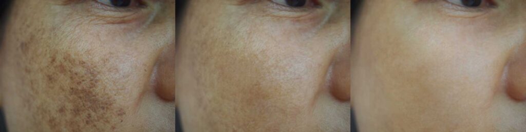 Melasma Treatment