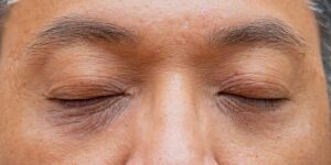 Under Eye Dark Circles Treatment