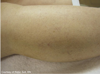 Close-up of a patchy, irritated skin area on a person's leg.