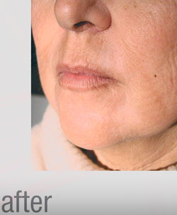 Laser resurfacing treatment to reduce / remove wrinkles