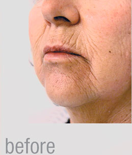 Laser Resurfacing for facial wrinkles