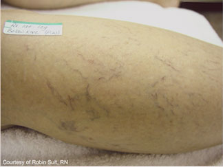 Varicose Leg Veins