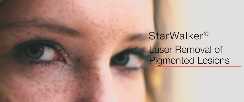 StarWalker Laser Removal of Pigmented Lesions