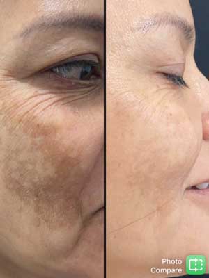 Melasma Before and After Treatment