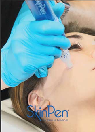 Microneedling with Platelet Rich Plasma