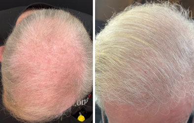 Hair loss restoration treatment - before and after