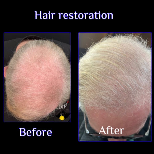 Hair loss treatment - before and after