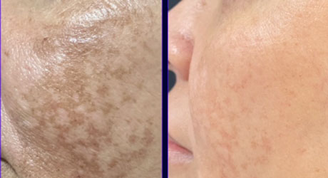 Melasma Treatment Before and After 4 treatments
