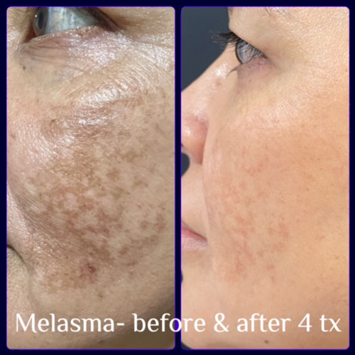 Melasma Treatment - before and after