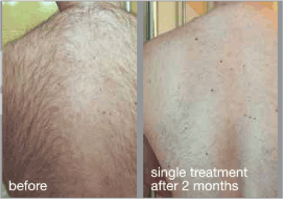 Laser Hair Removal