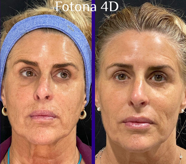 Fotona 4D Treatment Results