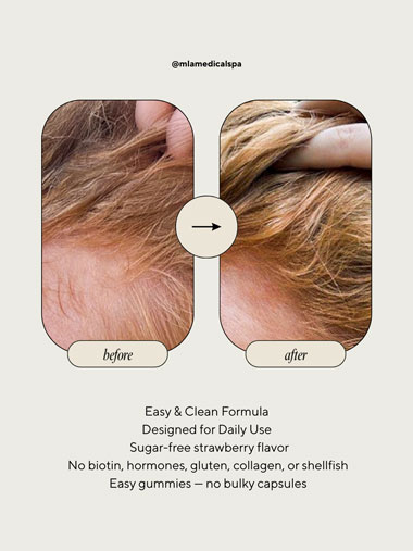 Xtresse hair care gummies- before and after