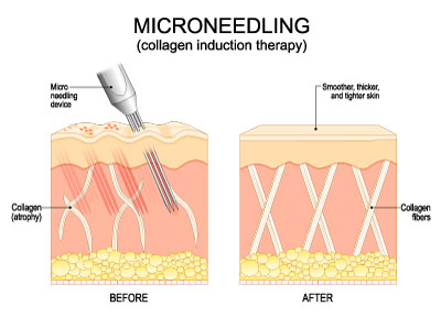 Microneedling to stimulate collagen
