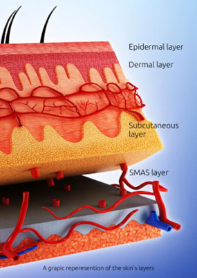 Fotona EndoTight Procedure Showing Skin Layers