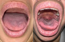 NightLase Snoring Results Case