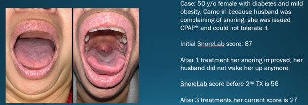 NightLase Results - Before and After