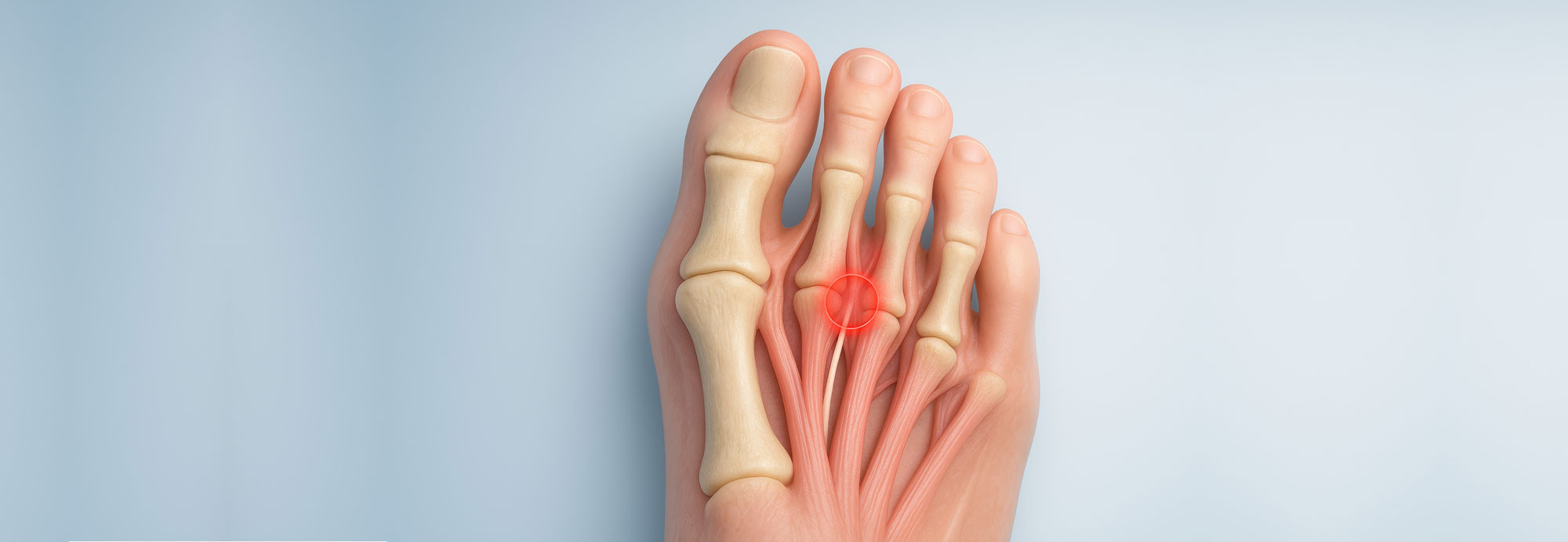Morton's Neuroma Laser Treatment