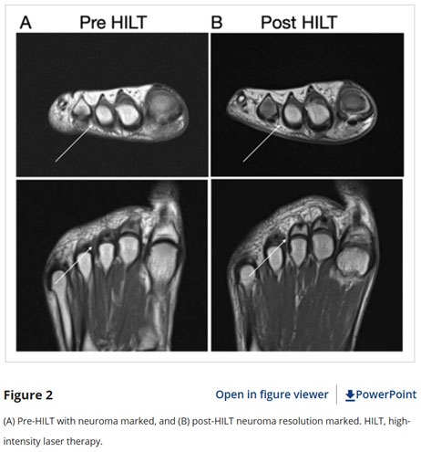 Pre-HILT with neuroma marked