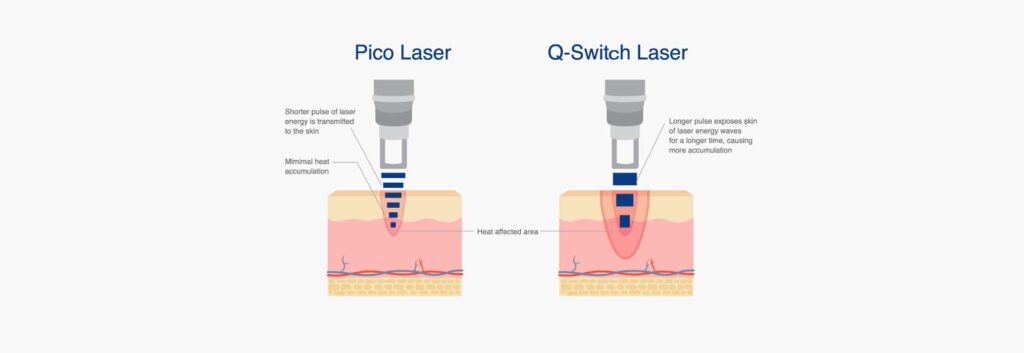Pico Second Laser compared to Q-Switch Laser for Tattoo Removal