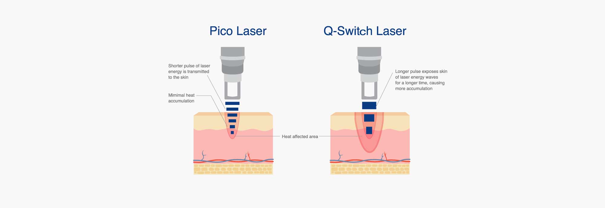 Pico Second Laser compared to Q-Switch Laser for Tattoo Removal