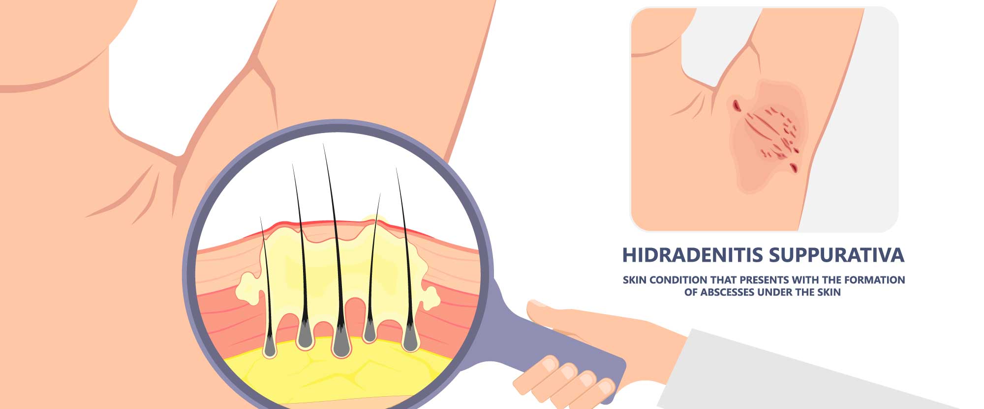 Laser Hair Removal Treatment for Acne Inversa