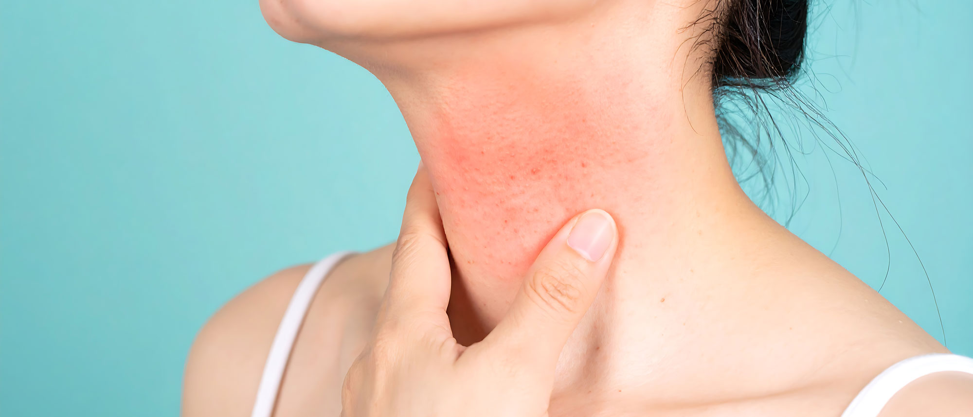 Poikiloderma of Civatte - women's neck rash