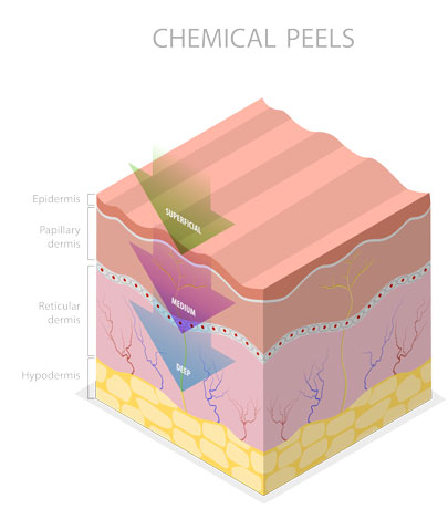chemical peels skin layers