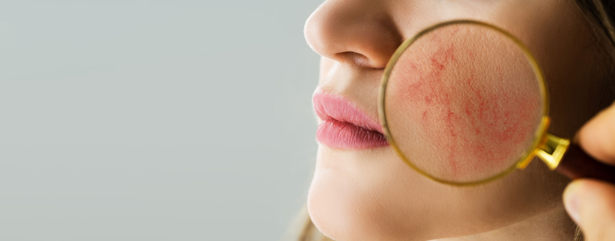 rosacea treatment with botulinum toxin for erythema in rosacea