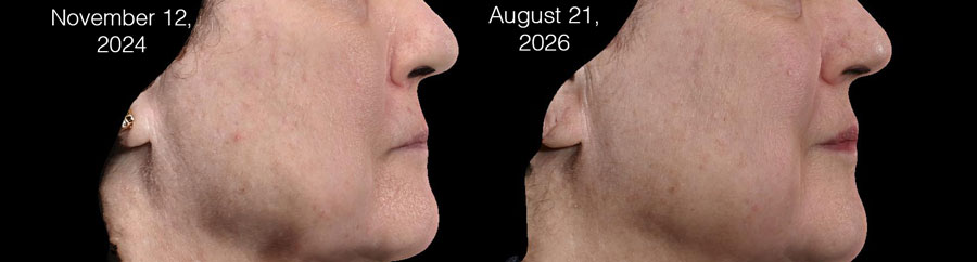 LipLase Lip Plumping Laser Treatment