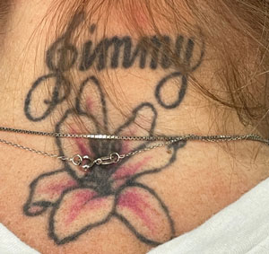 Laser Tattoo Removal Before Picture