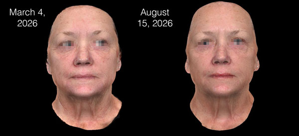 Skin Resurfacing Laser Treatment