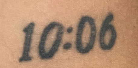 Laser Tattoo Removal Before Image
