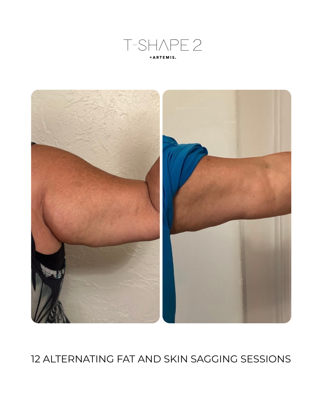 T-Shape 2 skin tightening after 12 treatments - before and after