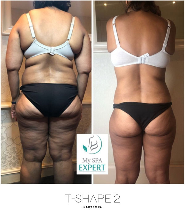 Before and After of Skin Tightening with the T-Shape 2 (after 10 treatments)