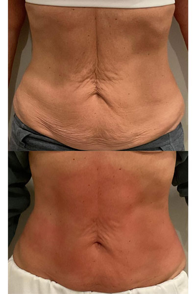 Skin Tightening with the T-Shape 2. Results after 2 treatments