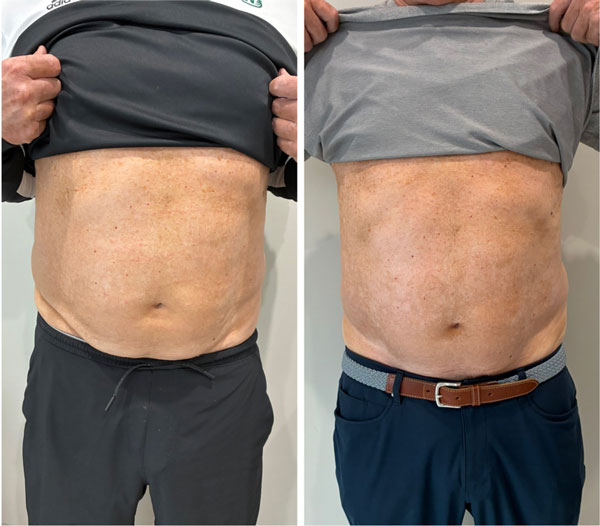 t-shape 2 skin tightening after two treatments